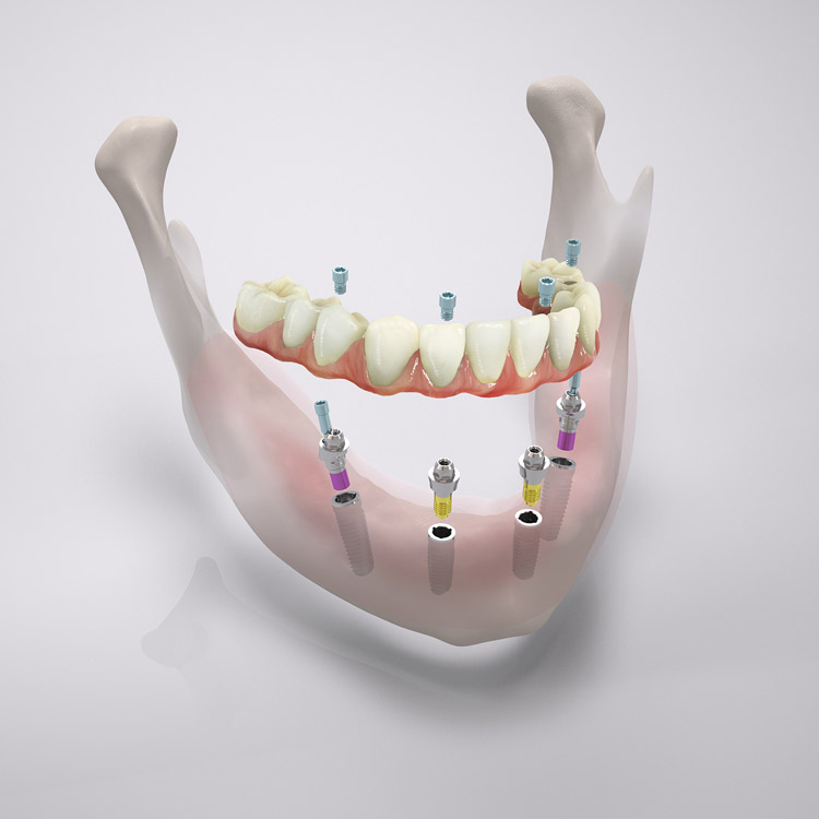 All-on-4® Feste Zähne sofort: Implantate in Hannover ohne zahnlos zu sein