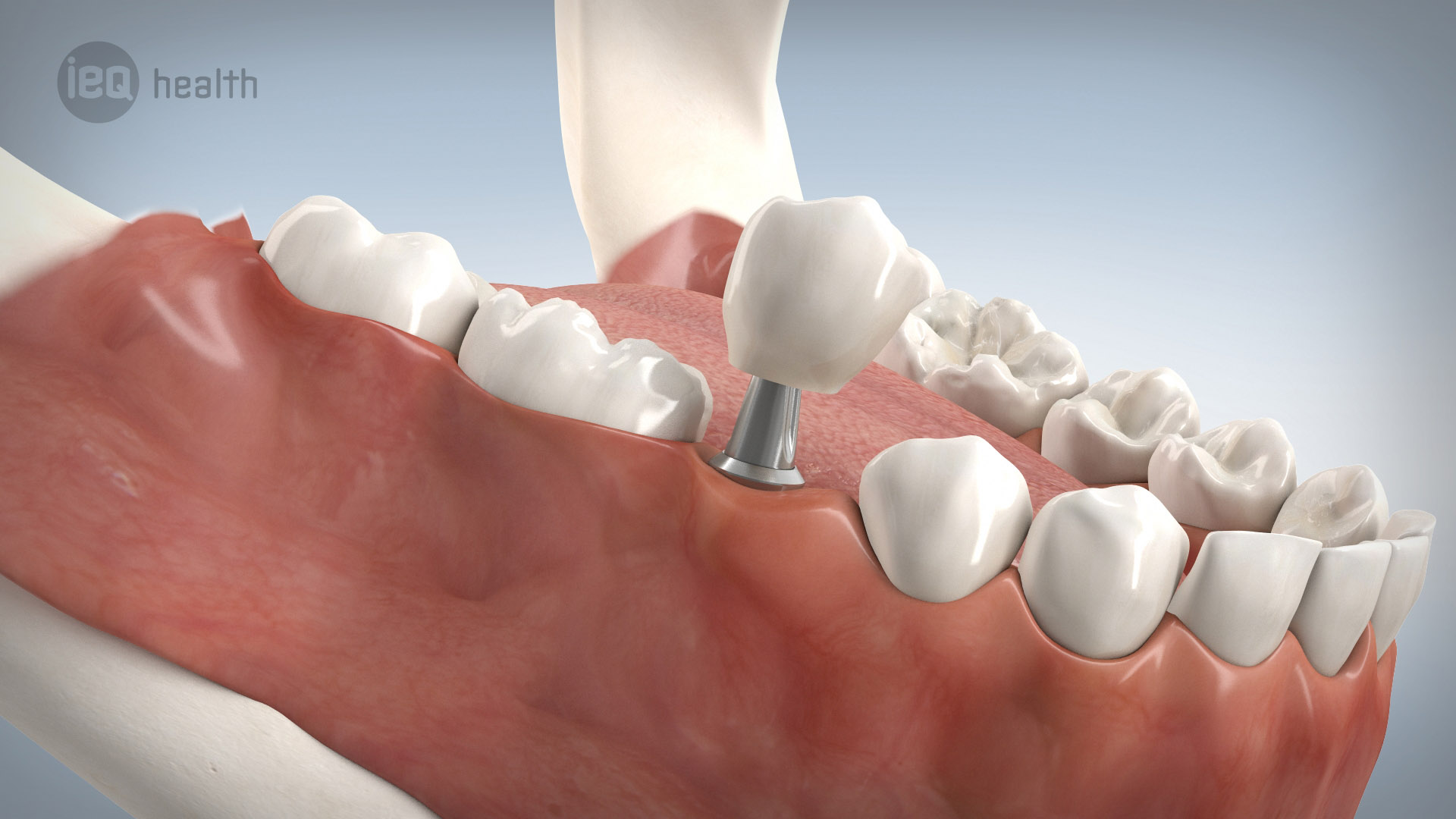 Erfahrung implantat zahn Zahnimplantat