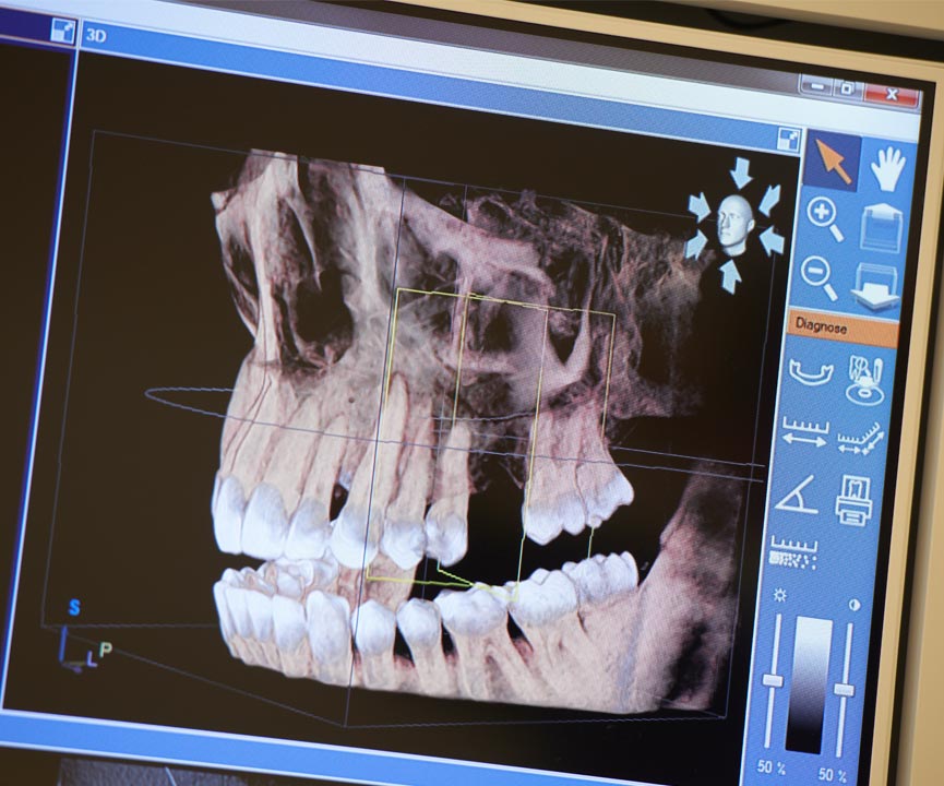 Zahnarzt Hannover 3D-Implantologie
