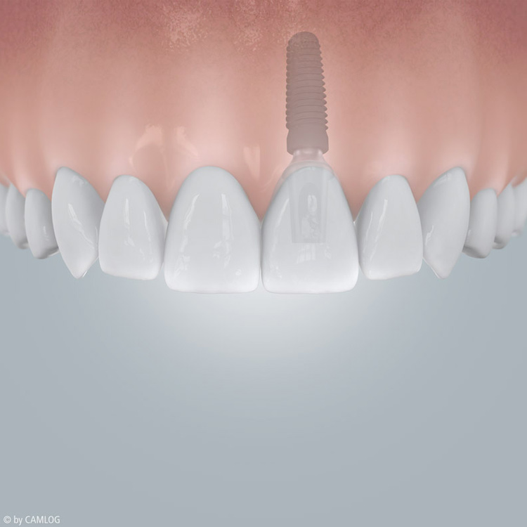 Zahn mit Implantat ersetzen in Hannover – Alternative zur Brücke