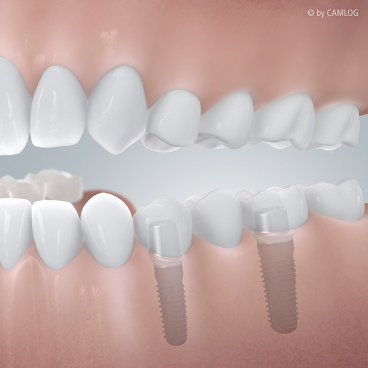 Gleich mehrere Zähne mit Implantaten ersetzen in Hannover