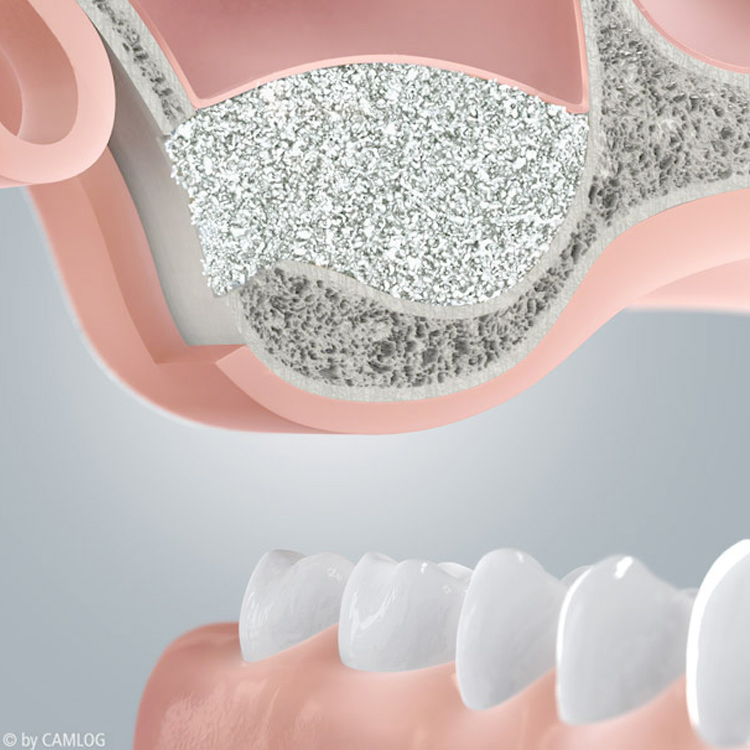 Knochenaufbau in Hannover: Zu wenig Kieferknochen für Implantat? 